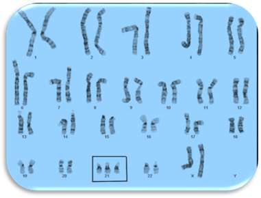 http://share.psu.ac.th/file/charunee.m/trisomy-21-highlighted1.jpg