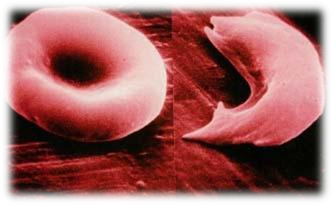 http://www.soyouwanna.com/images/sickle-cell-disease-facts-4360.jpg