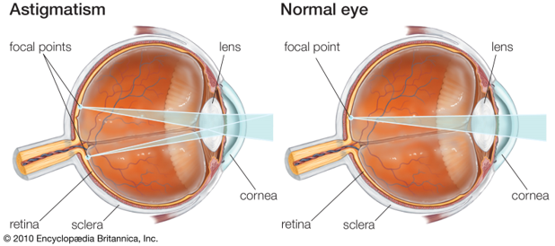 Uncorrected astigmatism on young children can also lead to Amblyopia.